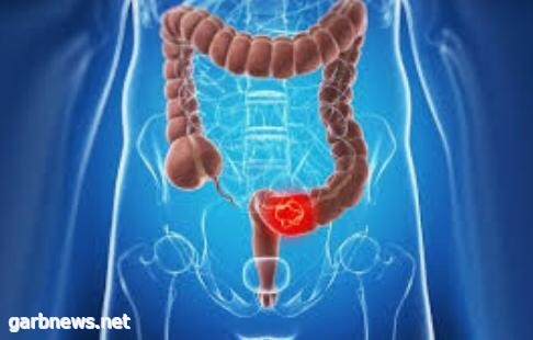 الصحة العامة بصحة بيشة بدأت في الكشف المبكر لسرطان القولون بين الرجال والنساء