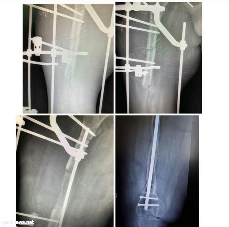 الأولى من نوعها بالمملكة.. باستخدام جهاز "الإليزاروف" بمستشفى عسير المركزي.. عملية نوعية لتعويض نصف عظمة الفخذ