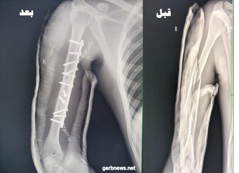 مستشفى الأسياح   ينجح في تثبيت كسر متفتت لشاب ناتج من حادث مروري