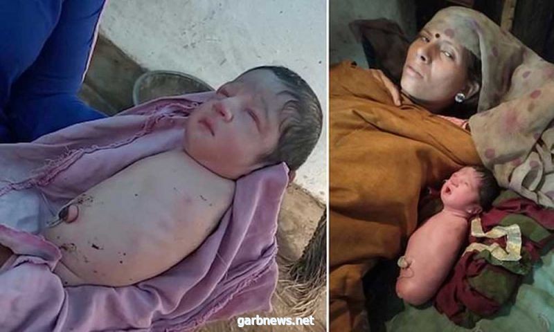 ولادة طفلة في  الهند بلا ذراعين أو أرجل