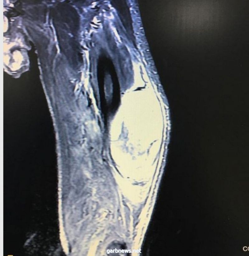استئصال ورم وزنه 2 كيلوجرام من فخذ معمّر سعودي بالرياض