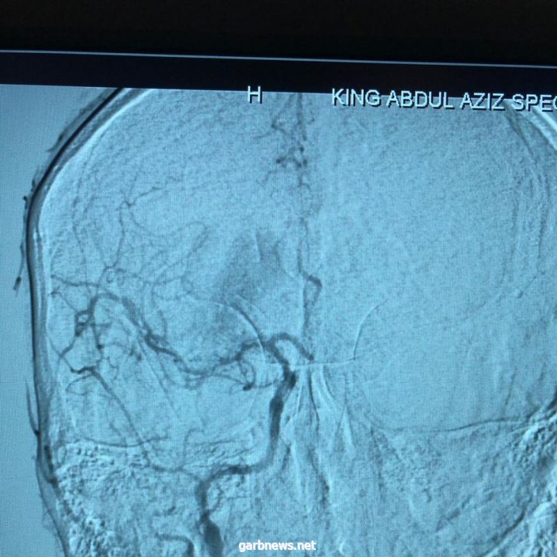 تدخل طبي بتخصصي الطائف يعيد الحركة والنطق لمريض أصيب بجلطة دماغية