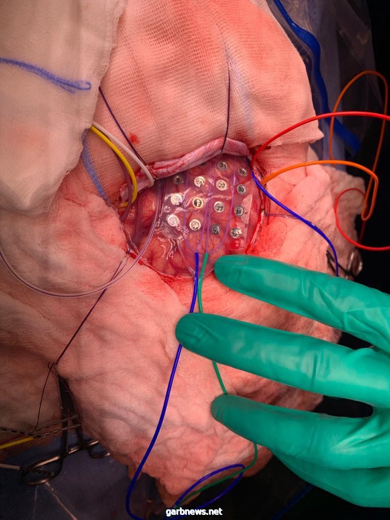 إيقاظ طفل خلال عملية جراحيه لتحديد الأماكن الحيوية في الدماغ في تخصصي الدمام