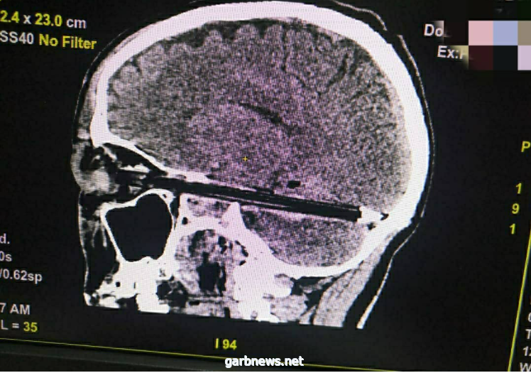 إنقاذ حياة شخص، بعد إخراج قلم من جمجمته،