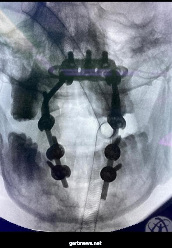 نجاح أربع عمليات بالعمود الفقري بمستشفى الملك خالد بالخرج