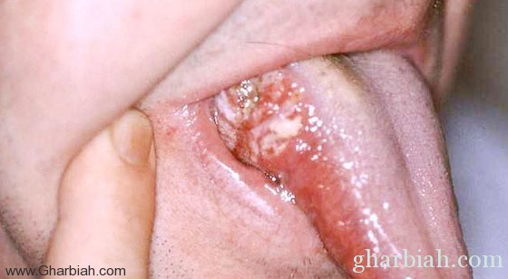إهمال صحة الفم والـ “غرغرة” قد تسبب “السرطان”