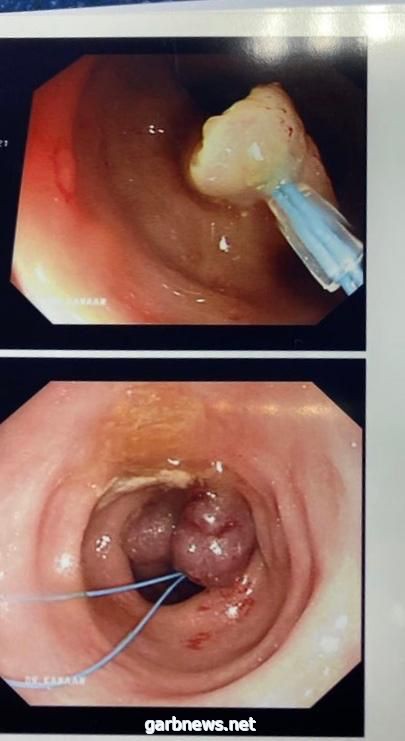 نجاح إستئصال ورم  من مريض خمسيني بإستخدام المنظار خلال ٣٠ دقيقة