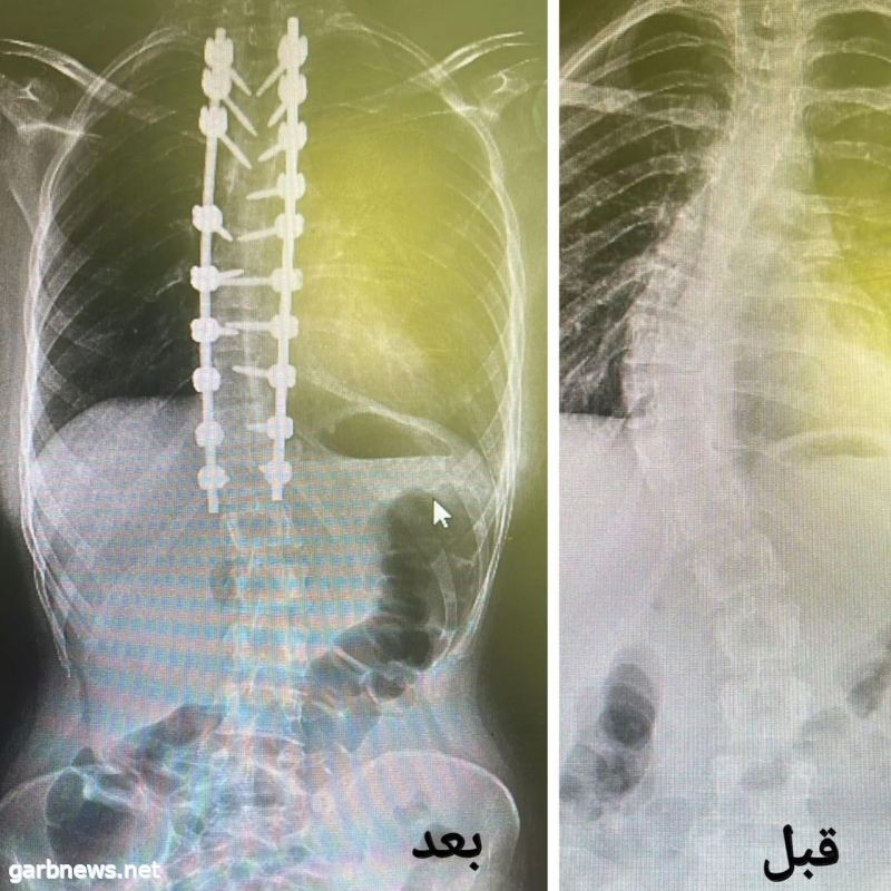 إنهاء معاناة فتاة بعملية جراحية نوعية في مجمع الملك عبدالله الطبي بجدة