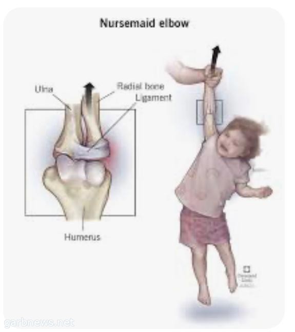 كوع المربية  Pulled Elbow