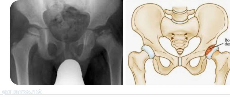 مرض بيرثيس Perthes' disease