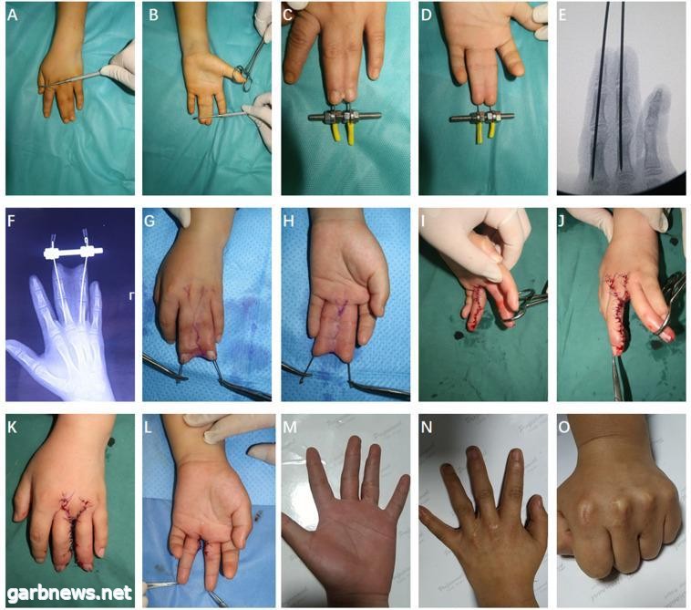 ارتفاق الأصابع  pediatric syndactyly