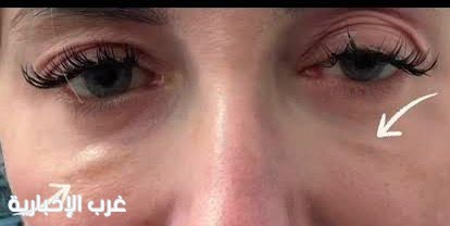 مخاطر الماكياج والعدسات التجميلية وعمليات التجميل على صحة العين مخاطر الماكياج والعدسات التجميلية وعمليات التجميل على صحة العين