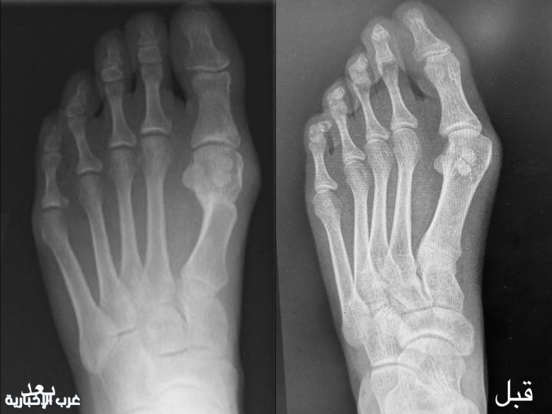 نجاح جراحة تصحيح إصبع القدم الكبير بمستشفى الإمام عبدالرحمن الفيصل