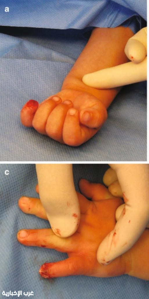 إصابات أطراف الأصابع عند الأطفال شائعة..والتعامل الصحيح معها يعطي نتائج ممتازة