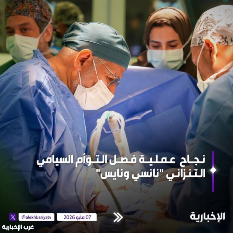 البرنامج السعودي للتوائم الملتصقة ينجح في فصل التوأم التنزاني «نانسي ونايس» بعد عملية استغرقت 16 ساعة