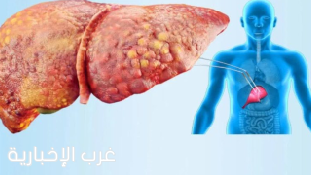 أبحاث حديثة :  فيتامين C قد يحمل فوائد واعدة في مواجهة مرض الكبد الدهني