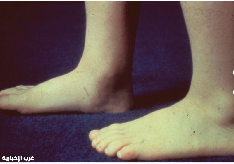تسطح القدمين عند الأطفال* (Flat Feet / Pes Planus)