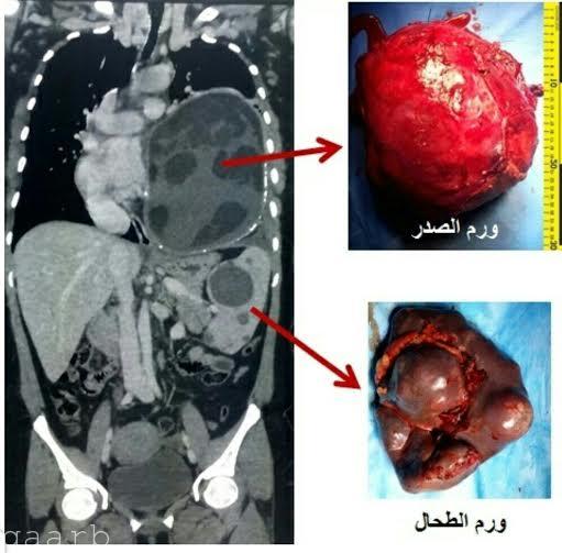 مجمع الملك فيصل الطبي بالطائف ينهي معاناة مريضة اربعينية من ورمين كبيرين بالصدر والبطن بعملية نادرة ومعقدة