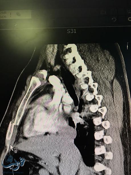 نجاح أول عمليه تثبيت للقفص الصدري بمستشفى الملك فهد بالباحه