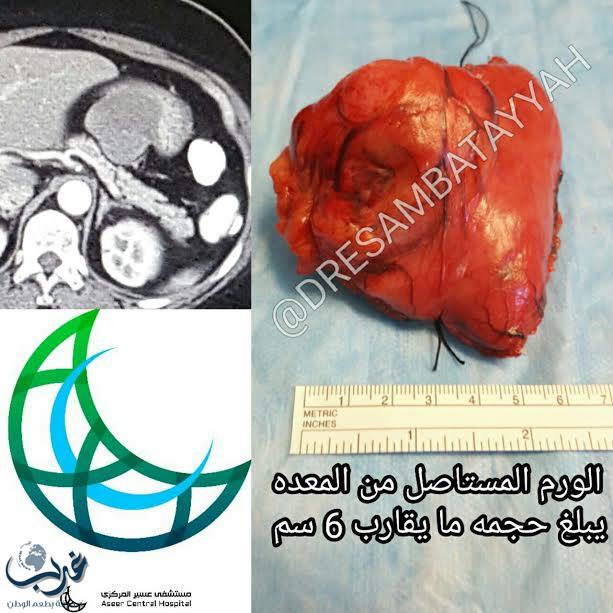 استئصال ورم سدوي من معدة مريضة بالمنظار الجراحي بمستشفى عسير المركزي