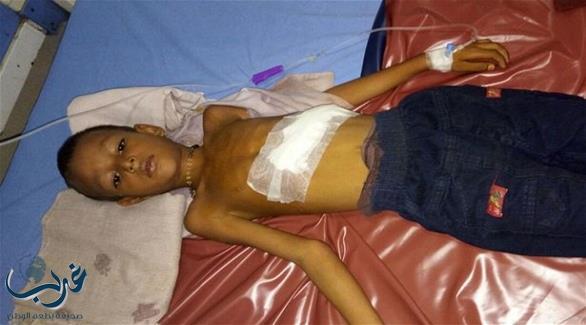 الهند: أطباء يكتشفون جنيناً غير مكتمل داخل بطن طفل في السادسة