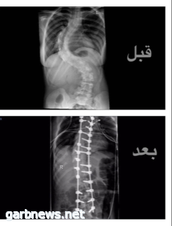 في جراحة استغرقت 8 ساعات نجاح عملية تقويم عمود فقري لفتاة بـ "سعود الطبية"