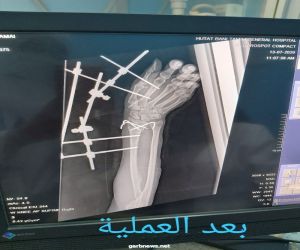 نجاح  عملية تجبير كسور متعددة لمصابة في مستشفى حوطة بني تميم العام