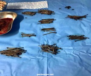 فريق طبي ينجح باستخراج 230 مسمارا من بطن مريض في جدة