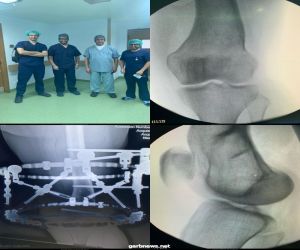إجراء أول عملية جراحية تُعمل خارج المستشفيات المتخصصة باستخدام المثبت الخارجي ( اليزاروف ) عبر التقنية البرمجية لتعديل و تطويل العظام