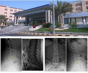 مستشفى الملك فهد الجامعي بالخبر ينجح في تغيير لغضروف الفقرات القطنية عن طريق البطن