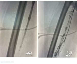 *مجمع الملك عبدالله الطبي في جدة ينهي معاناة حاجّة هندية*