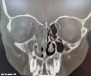 5 ساعات جراحية تنقذ طفل من فقدان بصره في جدة