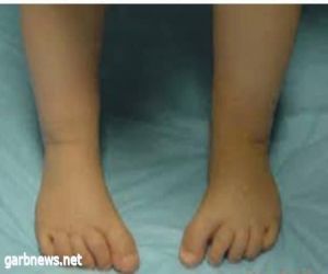 انحراف مقدمة القدم للداخل عند الأطفال "Metatarsus Adductus"