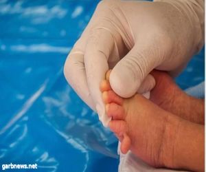 الأصابع الستة حالة وراثية والاستئصال الجراحي العلاج المناسب في سن مبكرة
