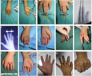 ارتفاق الأصابع  pediatric syndactyly