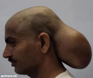هندي يعيش بـرأسين   لمدة 15 عاماً .. كيف تخلص  من الرأس ألإضافي ؟