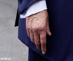 هل يهدد حياة ترامب؟ القصور الوريدي المزمن تحت المجهر