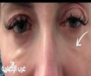 مخاطر الماكياج والعدسات التجميلية وعمليات التجميل على صحة العين مخاطر الماكياج والعدسات التجميلية وعمليات التجميل على صحة العين