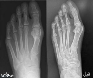 نجاح جراحة تصحيح إصبع القدم الكبير بمستشفى الإمام عبدالرحمن الفيصل