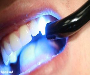 ​سر الابتسامة المتناسقة : هل تكفيك الحشوات أم تحتاج للتركيبات؟