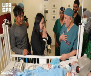 نجاح عملية فصل التوأم الفلبيني "أوليفيا وجيانا"