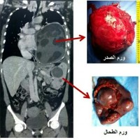 مجمع الملك فيصل الطبي بالطائف ينهي معاناة مريضة اربعينية من ورمين كبيرين بالصدر والبطن بعملية نادرة ومعقدة