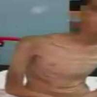 فيديو .. طفل في صورة شبيهة بالهيكل العظمي بسبب التجويع في محافظة خيبر