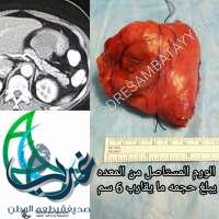 استئصال ورم سدوي من معدة مريضة بالمنظار الجراحي بمستشفى عسير المركزي