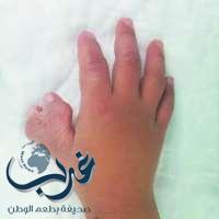 عملية جراحية ناجحة لإصلاح تشوه إبهام مزدوج لطفل سعودي