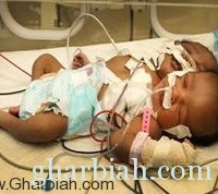 ولادة طفل "برأسين" في جسد واحد في زيمبابوي!