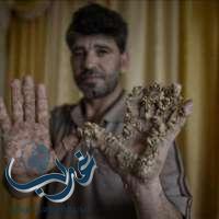 مرض نادر يصيب فلسطينياً ويحول يديه إلى “جذع شجرة”