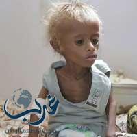 "يونيسيف": 3 ملايين طفل يعانون من سوء التغذية في اليمن