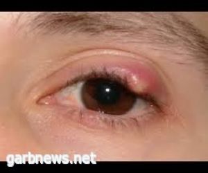أسباب ظهور «دمل العين».. وكيفية علاجه