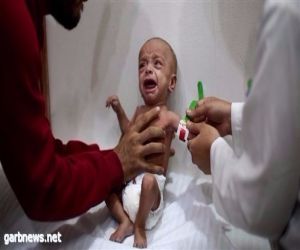 اليونيسيف: الغوطة الشرقية تشهد أعلى نسبة سوء تغذية منذ 2011